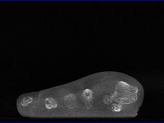 1st MT bone spur
